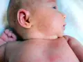 Malutkie krosty na ciele niemowlaka, widoczne na twarzy, szyi i klatce piersiowej, mogą być powodem do niepokoju rodziców.