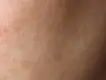 Zbliżenie na twarz z widoczną łuszczącą się skórą, która wymaga nawilżenia.