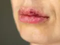 Usta z zaczerwienieniem i siniakami, możliwe kwas hialuronowy efekty uboczne po zabiegu.