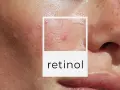 Zbliżenie na skórę z widocznymi niedoskonałościami, zaczerwienieniami i wypryskami. W ramce tekst "retinol", sugerujący wysyp po retinolu.