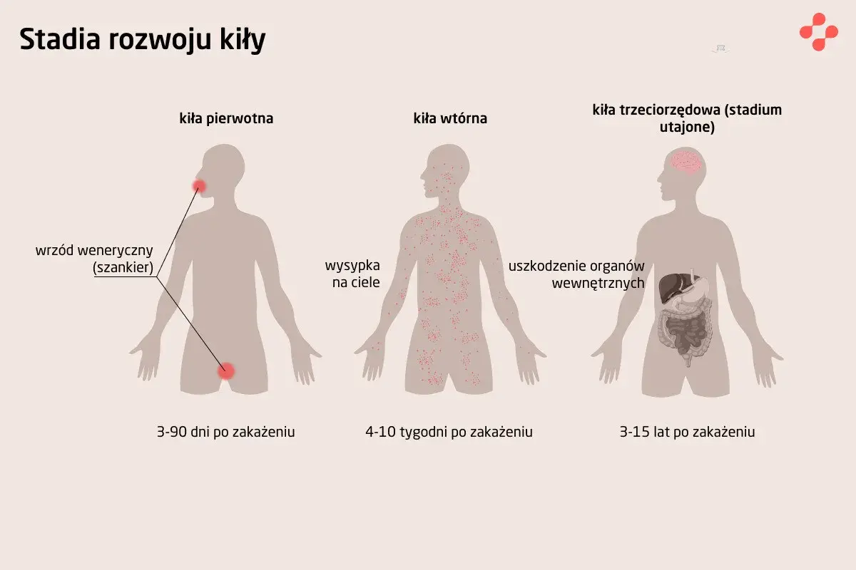 Ilustracja przedstawia stadia rozwoju kiły: pierwotna (wrzód), wtórna (wysypka skórna) i trzeciorzędowa (uszkodzenia narządów).