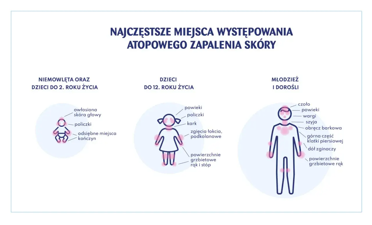Ilustracja pokazuje najczęstsze miejsca atopowego zapalenia skóry u niemowląt, dzieci i dorosłych.