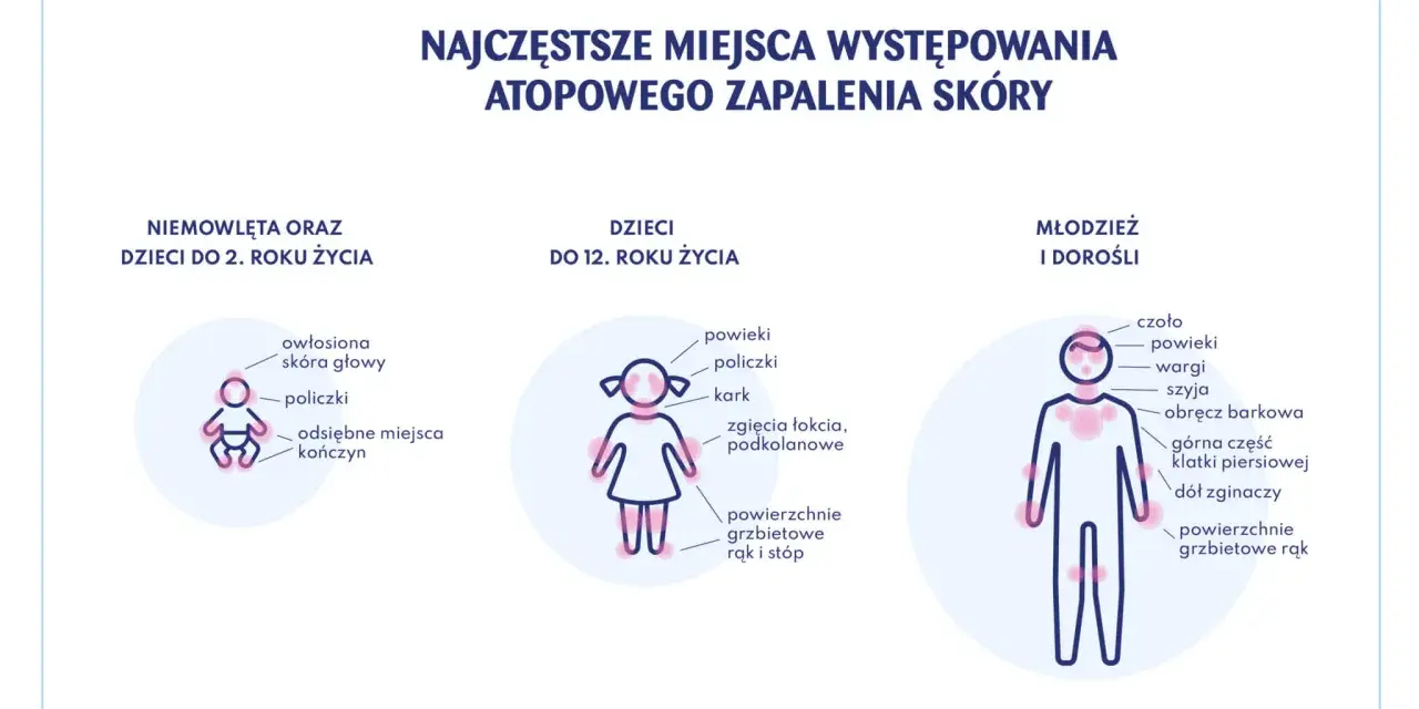 Ilustracja pokazuje najczęstsze miejsca atopowego zapalenia skóry u niemowląt, dzieci i dorosłych.