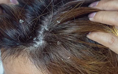 Widoczne białe płatki na ciemnych włosach. Czy to łupież? Dowiedz się, dandruff co to jest i jak sobie z nim radzić.