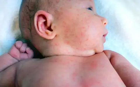 Malutkie krosty na ciele niemowlaka, widoczne na twarzy, szyi i klatce piersiowej, mogą być powodem do niepokoju rodziców.