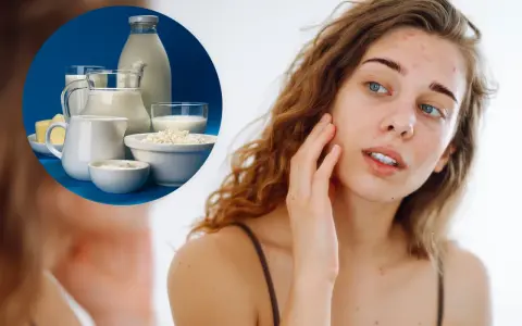 Młoda kobieta z trądzikiem hormonalnym dotyka twarzy, zastanawiając się, czy nietolerancja laktozy może być przyczyną jej problemów skórnych. W tle produkty mleczne.