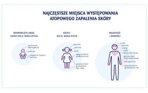 Ilustracja pokazuje najczęstsze miejsca atopowego zapalenia skóry u niemowląt, dzieci i dorosłych.