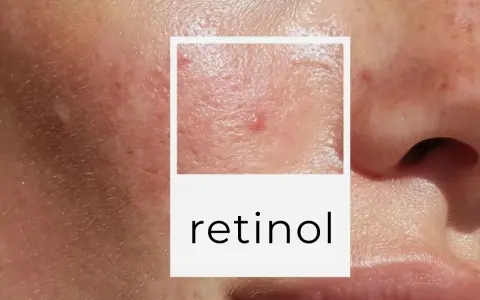 Skóra po dermapenie, widoczne drobne blizny i zaczerwienienia. W ramce napis "retinol", sugerujący pielęgnację.