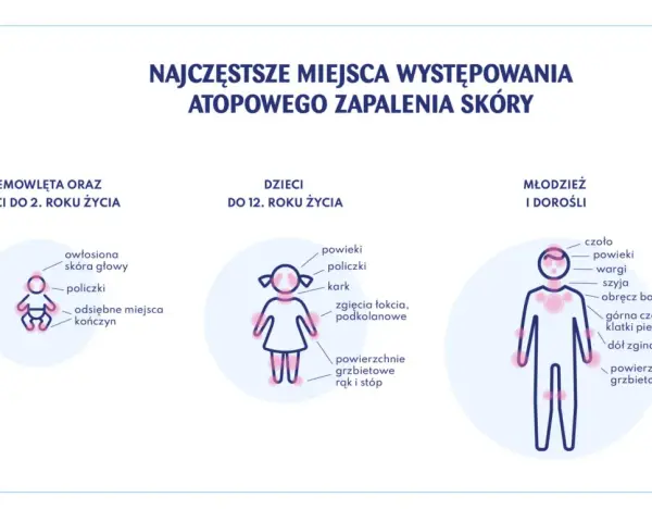Ilustracja pokazuje najczęstsze miejsca atopowego zapalenia skóry u niemowląt, dzieci i dorosłych.