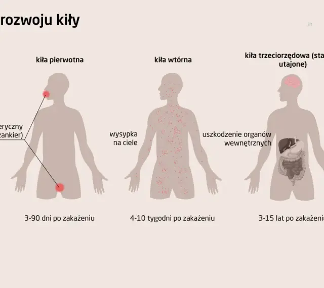 Ilustracja przedstawia stadia rozwoju kiły: pierwotna (wrzód), wtórna (wysypka skórna) i trzeciorzędowa (uszkodzenia narządów).