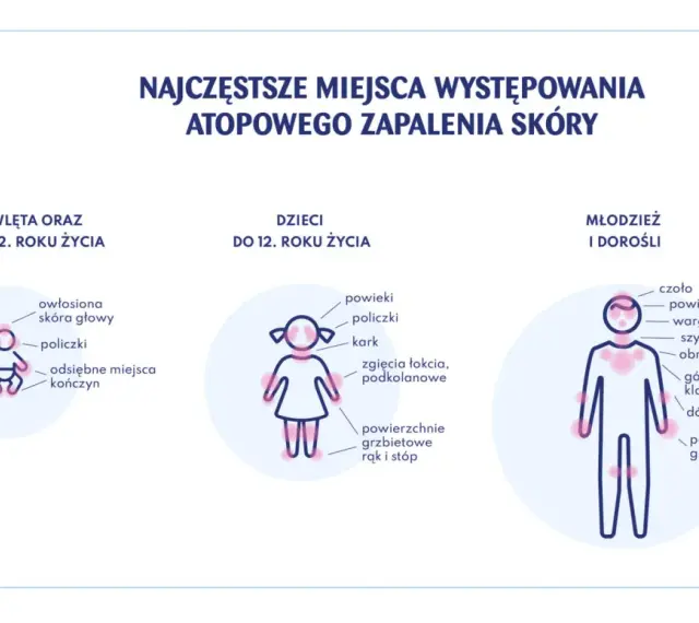 Ilustracja pokazuje najczęstsze miejsca atopowego zapalenia skóry u niemowląt, dzieci i dorosłych.