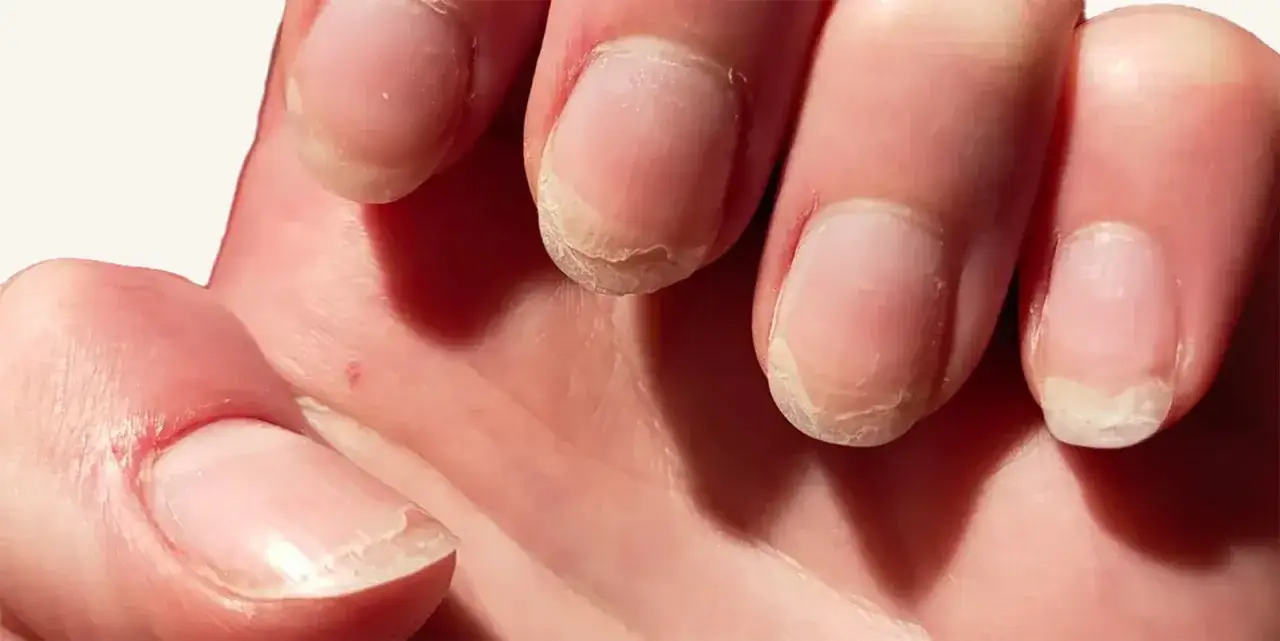 Dłonie z widocznymi, suchymi paznokciami, które potrzebują regeneracji. Marzysz o zdrowym blasku jak po manicure japońskim?