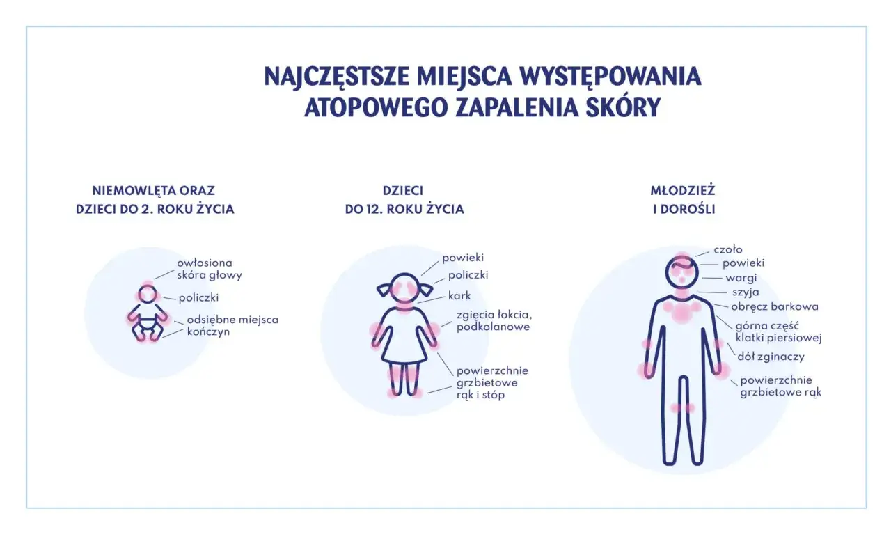 Ilustracja pokazuje najczęstsze miejsca występowania atopowego zapalenia skóry u niemowląt, dzieci i dorosłych.