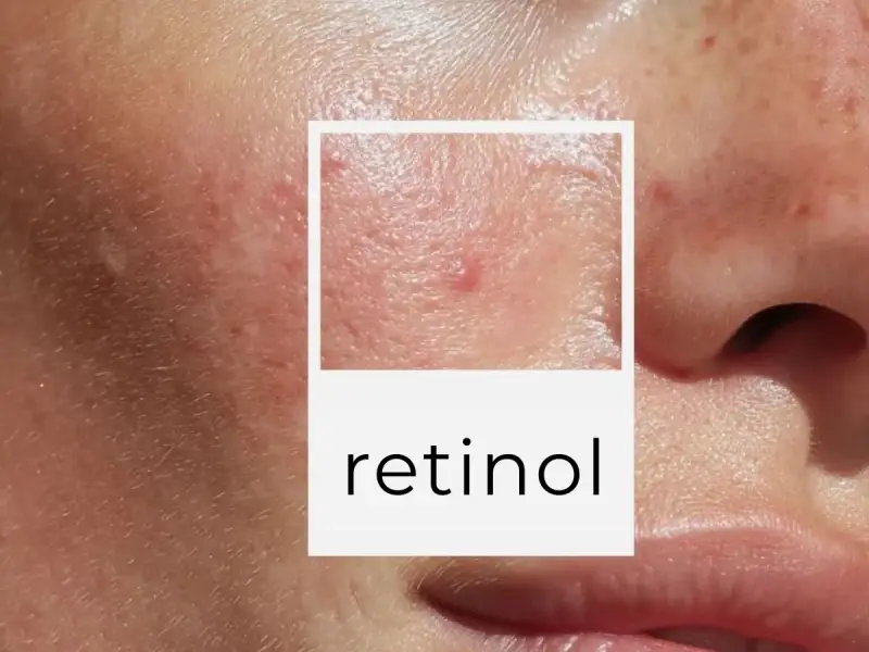 Skóra po dermapenie, widoczne drobne blizny i zaczerwienienia. W ramce napis "retinol", sugerujący pielęgnację.